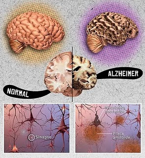 A fisioterapia na Doença de Alzheimer