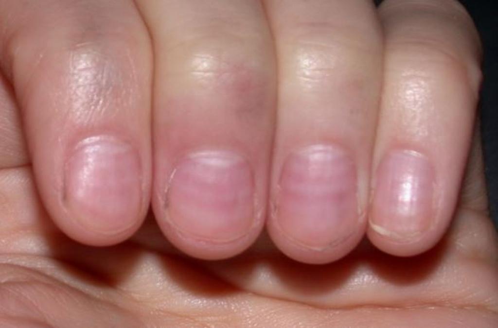 15 Signes Alarmants Que Vos Ongles Pourraient Révéler Sur Votre Etat De