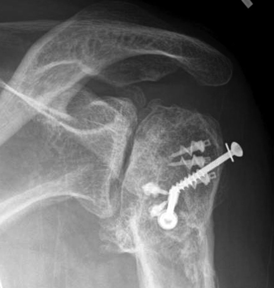 UW Shoulder and Elbow Academy Post traumatic arthritis of the shoulder