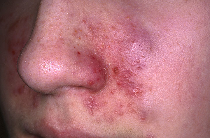 seborrheic dermatitis face treatments