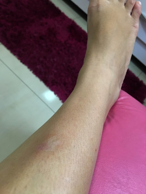 cicatriz na perna