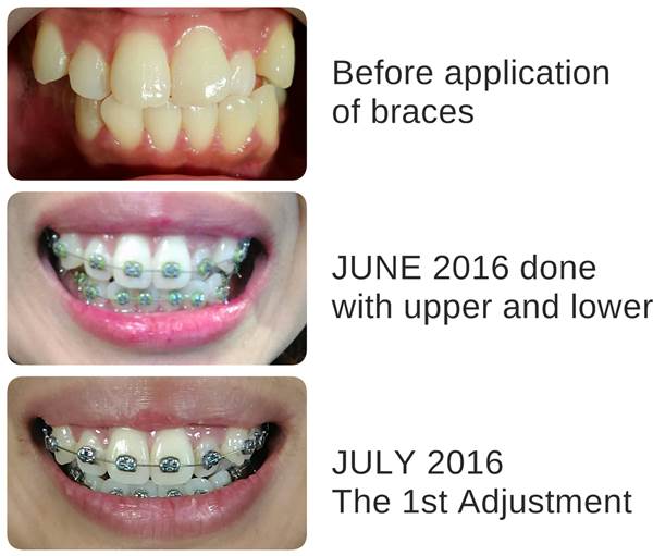 My Brace Experience 1st Month