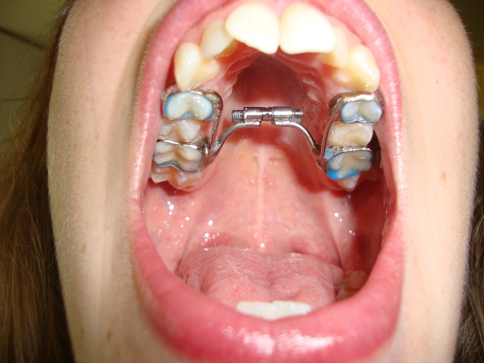 expander adult face bad brace getting much kid