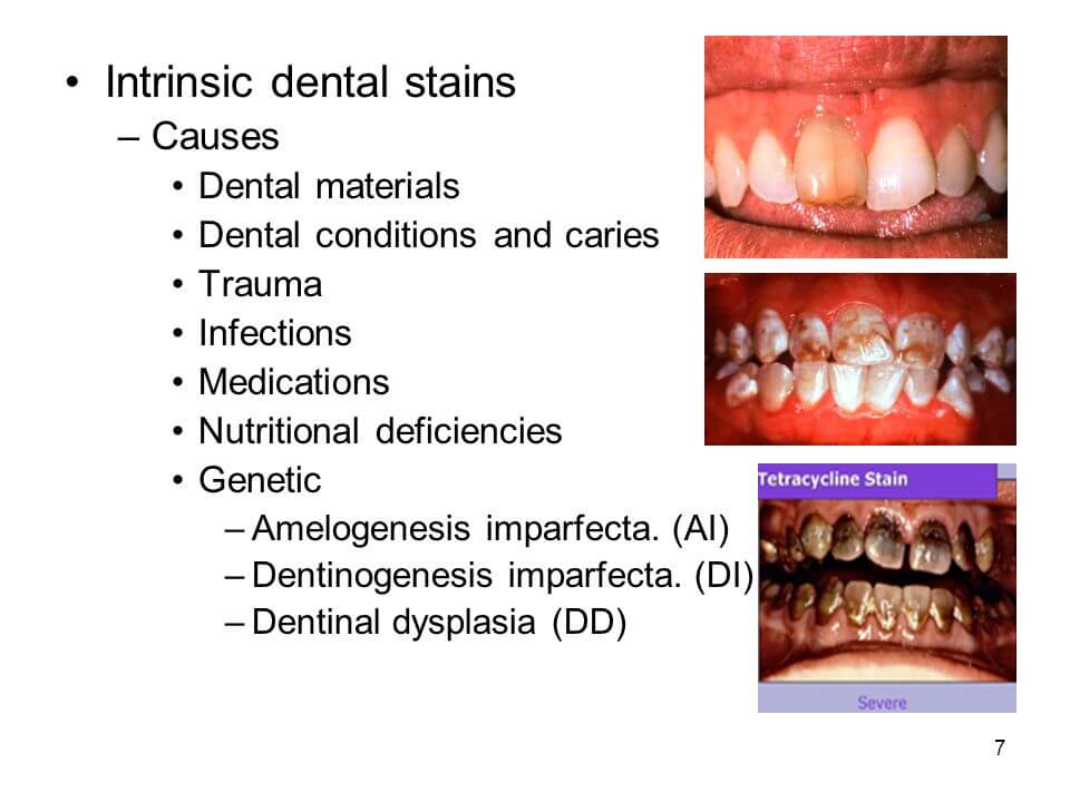 Causes Of Intrinsic Stains On Teeth TeethWalls