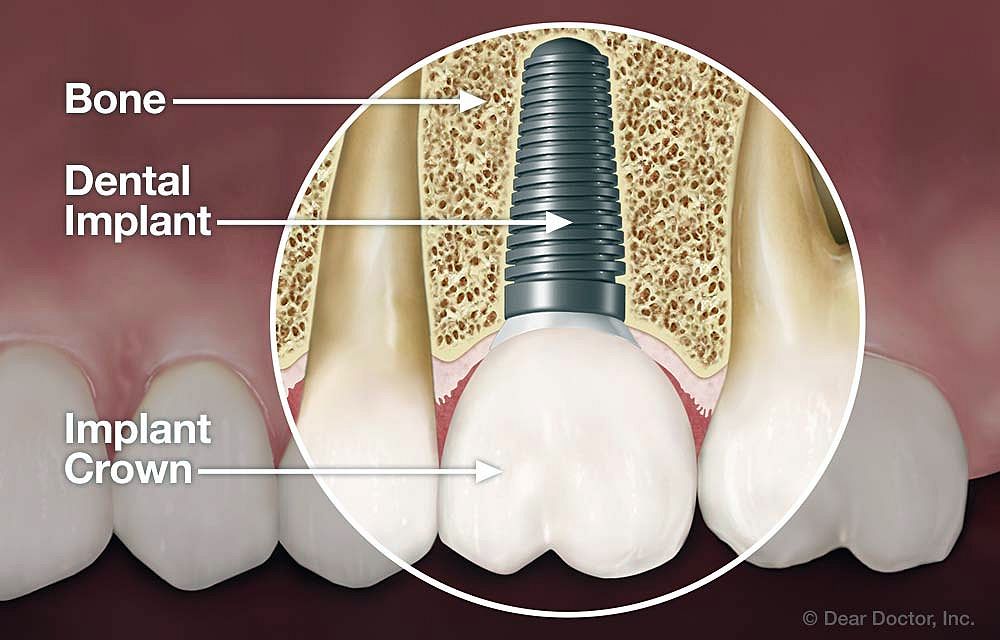 DENTAL IMPLANTS What types of implant are used today?