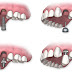 Nhiều bệnh nhân lo lắng cấy răng implant sẽ đau lắm?
