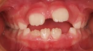 Pediatric Dentist, Bangalore: August 2014