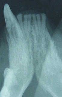 Radiograph of a diseased canine tooth