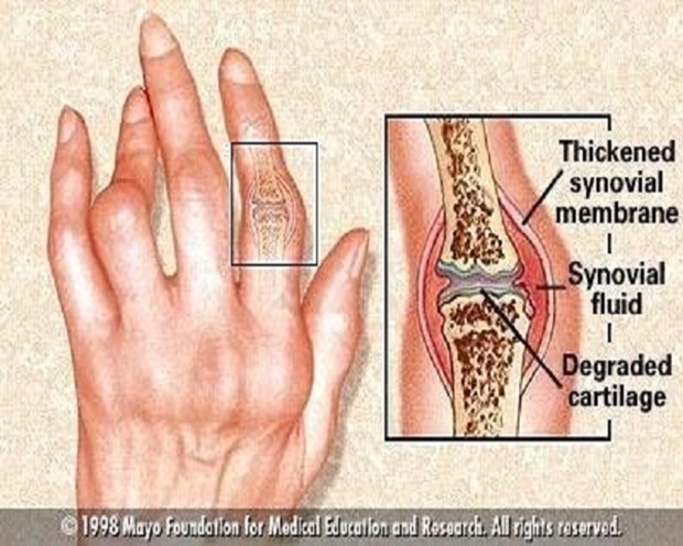 soda bikarbona artritis liječenje artritisa bol u zglobovima lijeva ruka