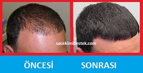 saç mezoterapisi öncesi ve sonrası 10