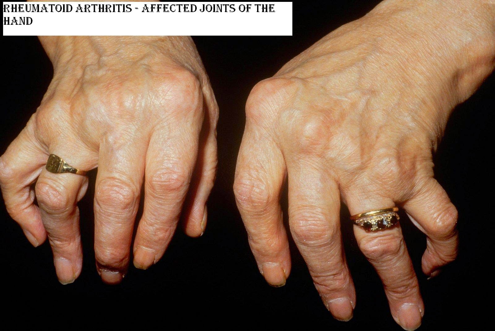 Arthritis Health and Disease
