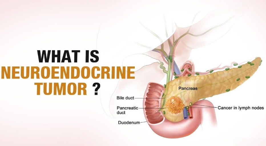 What Is The Prognosis For Neuroendocrine Cancer