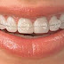 Phương pháp niềng răng mắc cài sứ trị hô