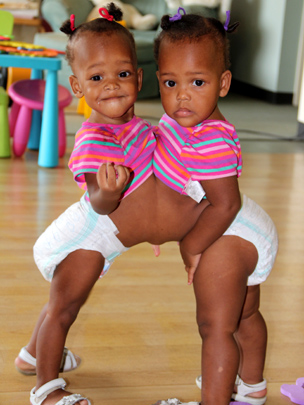 kmhouseindia: Conjoined Twins