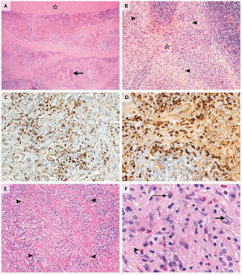 IgG4-Related Disease | Annual Review of Pathology ...
