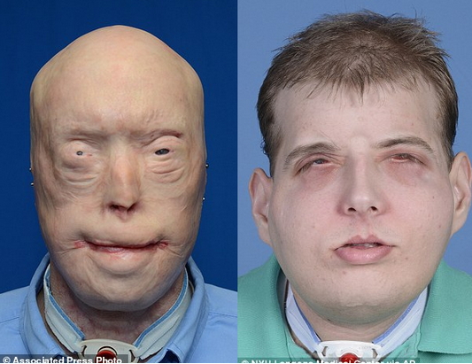 Pat Hardison face transplant