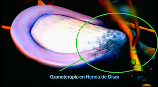La hernia de disco intervertebral se puede curar con Ozonoterapia