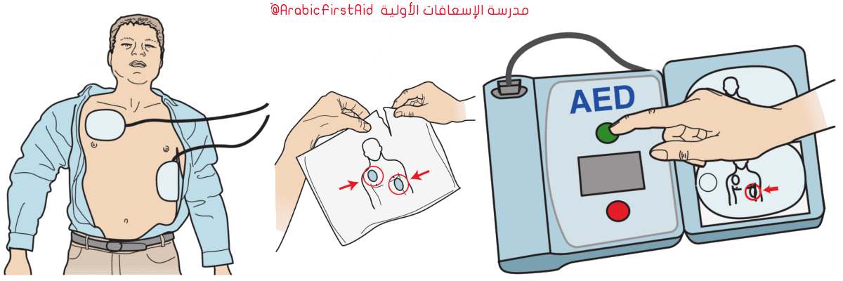 تقنيات (الإسعافات الإولية و الطوارئ) First-Aid-use-aed-Defibrillator-2