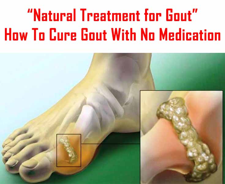 Easy Gout Treatment and Prevention Tips Natural Treatment for Gout