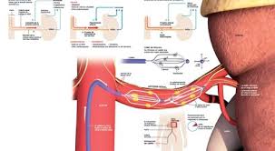 Denervación renal basada en catéter para medicamentos resistentes a la hipertensión Denervación renal basada en catéter para medicamentos resistentes a la hipertensión