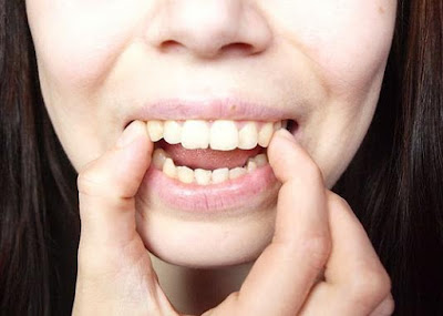 Bị hô có nên bọc răng sứ không?