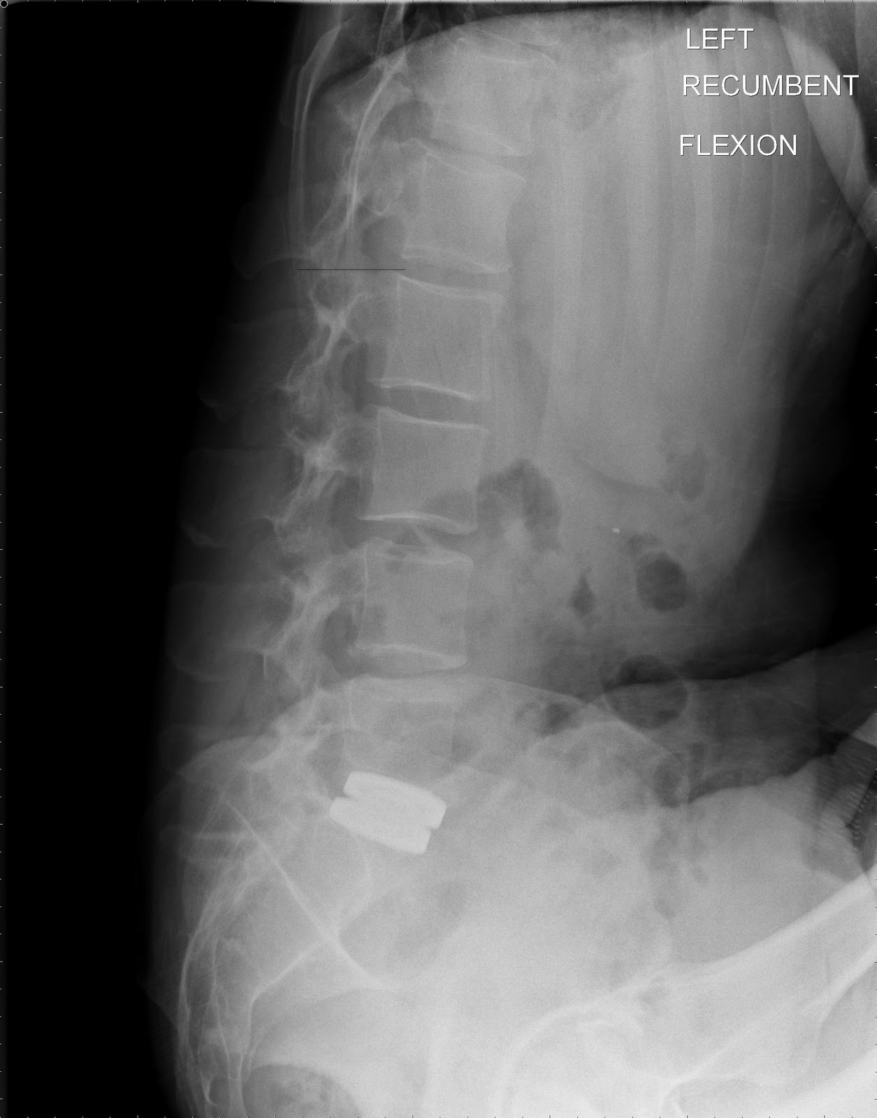 l2 l3 herniated disk xray images
