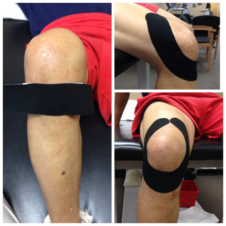 Kinesiology Taping for Knee Pain Physio Answers