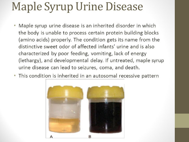 maple syrup urine disease other names