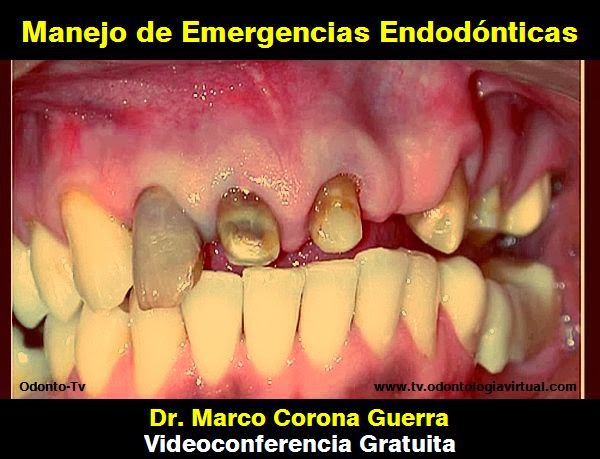EMERGENCIAS ENDODÓNTICAS: Manejo en el consultorio - Dr. Marco Corona Guerra