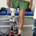 Firence, këmbët e para bionike në botë