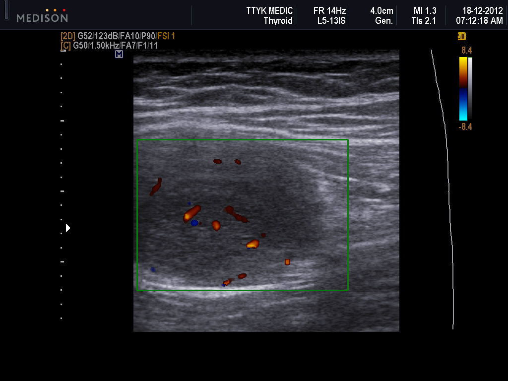 Vietnamese Medic Ultrasound Case Intramuscular Mass Dr Phan