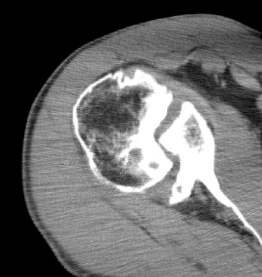 Shoulder Arthritis / Joint Replacement A difficult combination