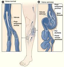 varicoza venelor profunde mkb 10