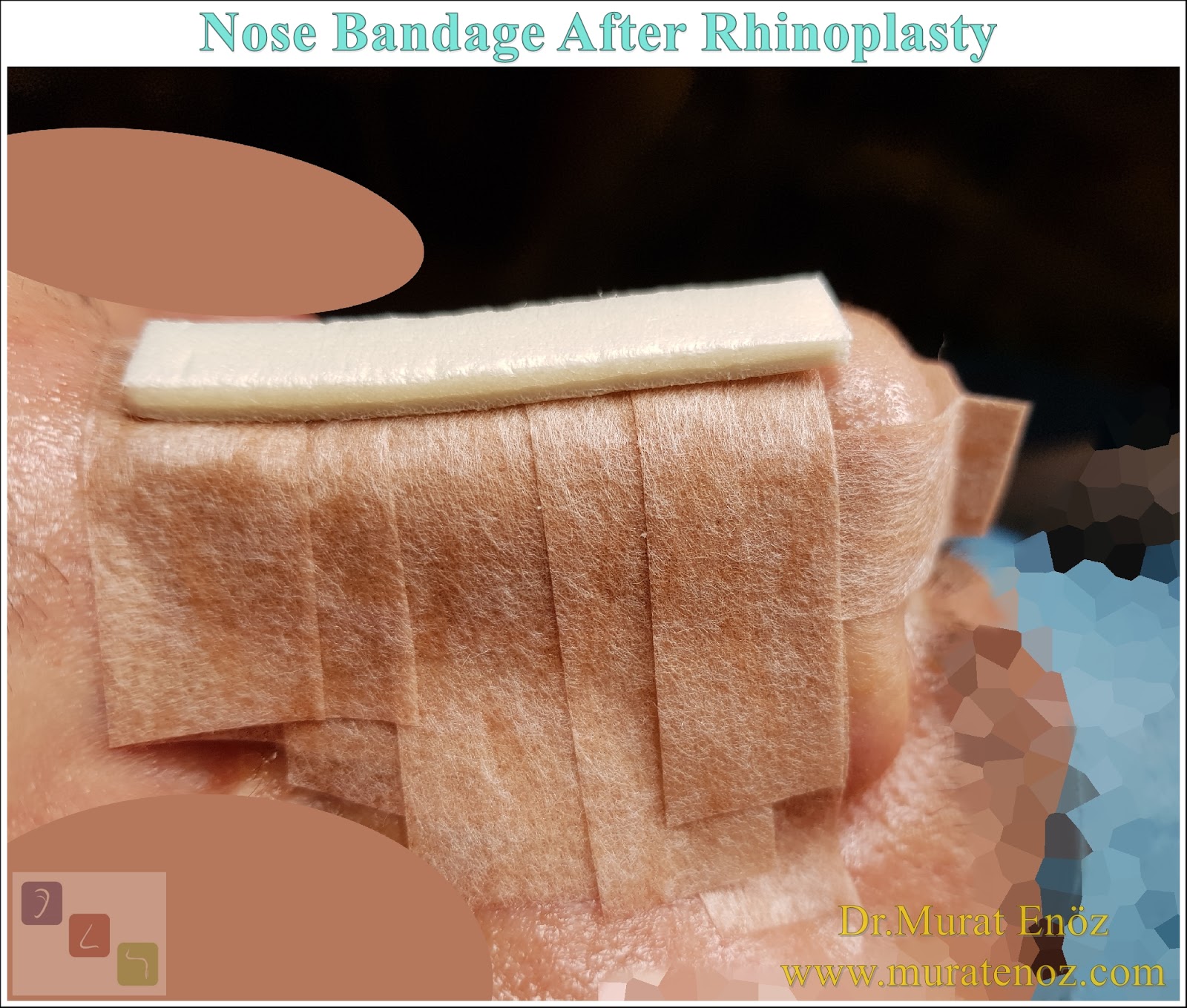 What Is The External Nasal Splint, Why it is Used and How Is It Taken Off?