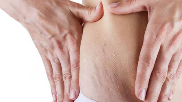 5 Cara Alami Untuk Mengencangkan Kulit yang Mulai Kendur 5 Cara Alami Untuk Mengencangkan Kulit yang Mulai Kendur