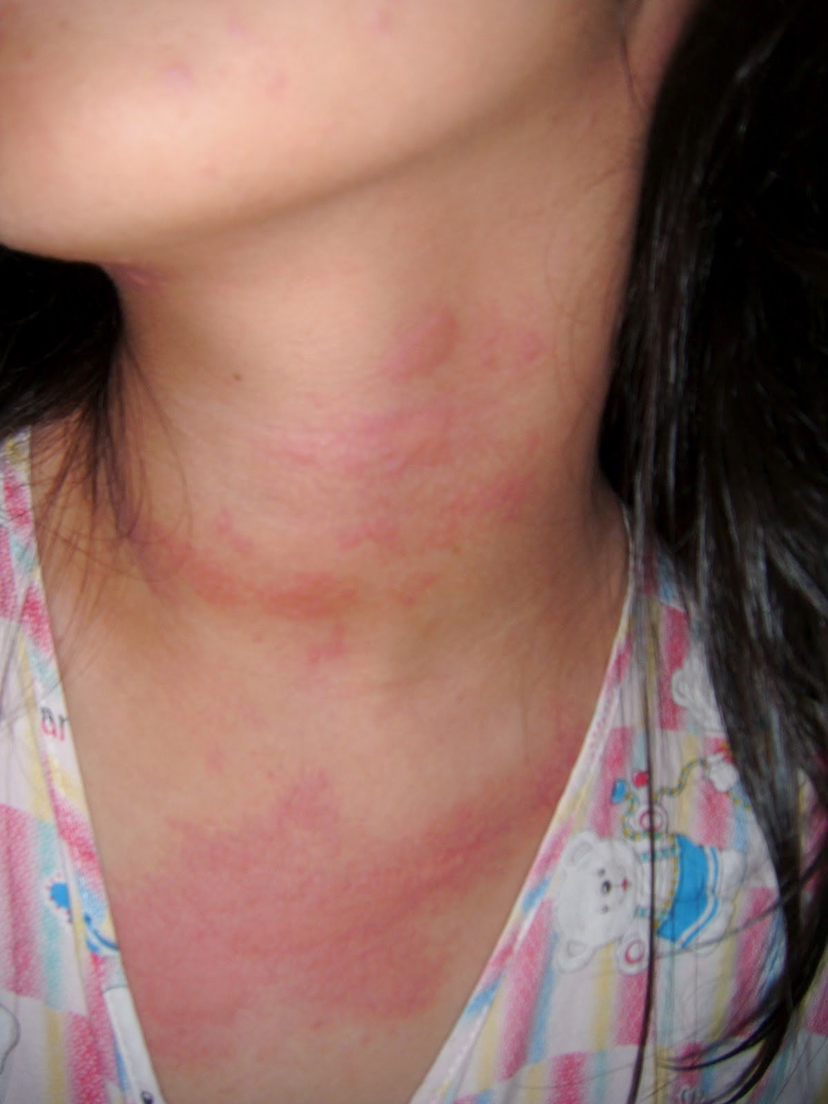 http://kesehatan-site.blogspot.com/2014/07/mengatasi-alergi-dengan-cara.html