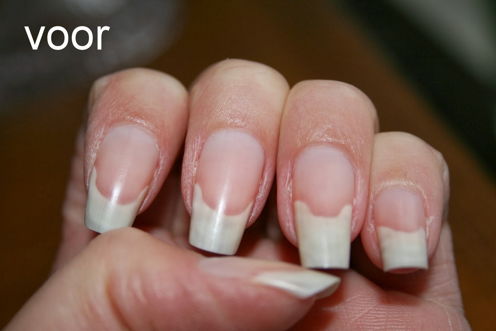 Can Crohn's and Ulcerative Colitis Affect Your Fingernails? |  MyCrohnsAndColitisTeam