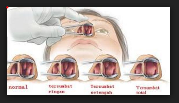 Punca Hidung Tersumbat dan Cara Memulihkannya  Sila Share