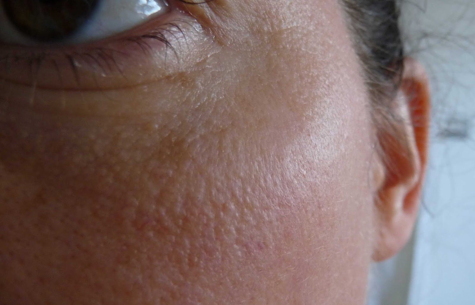 Scarlet Letters, dealing with vascular rosacea, face flushing, burning and the rest IPL or
