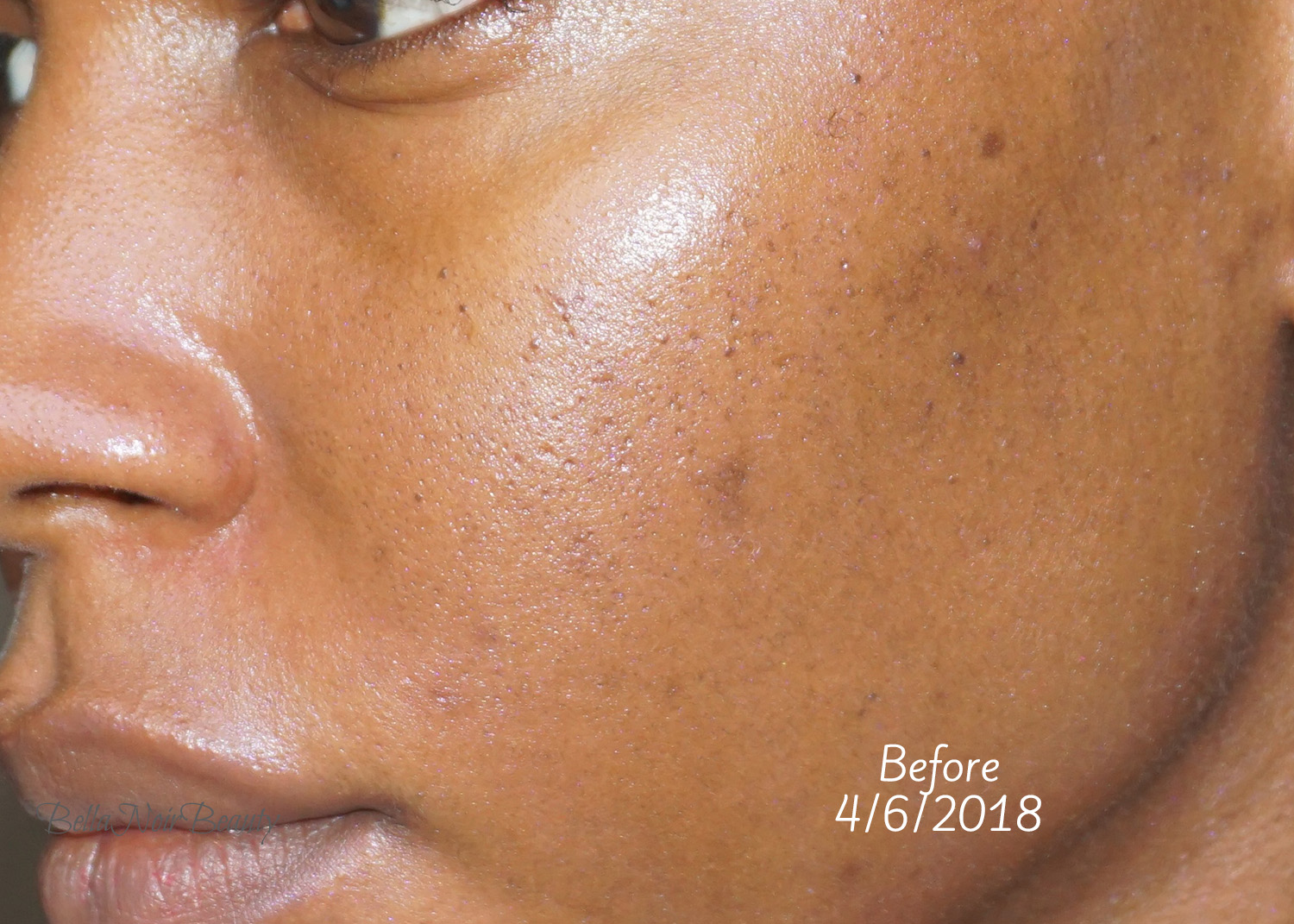 Review Here's What The Ordinary Mandelic Acid 10 Did to My Skin