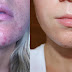How to Remove Pimples | मुहांसे कैसे भी हो छुटकारा पाना चाहते है तो आज ही करे ये
घरेलु उपाय