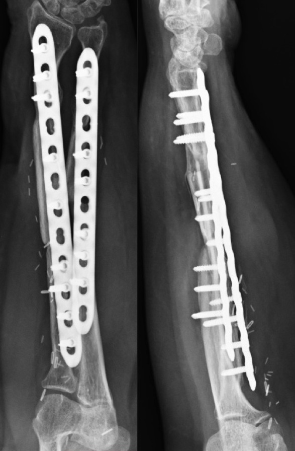 Interesting Case Studies from www.ilizarov.in: Case 3 - Infected ...