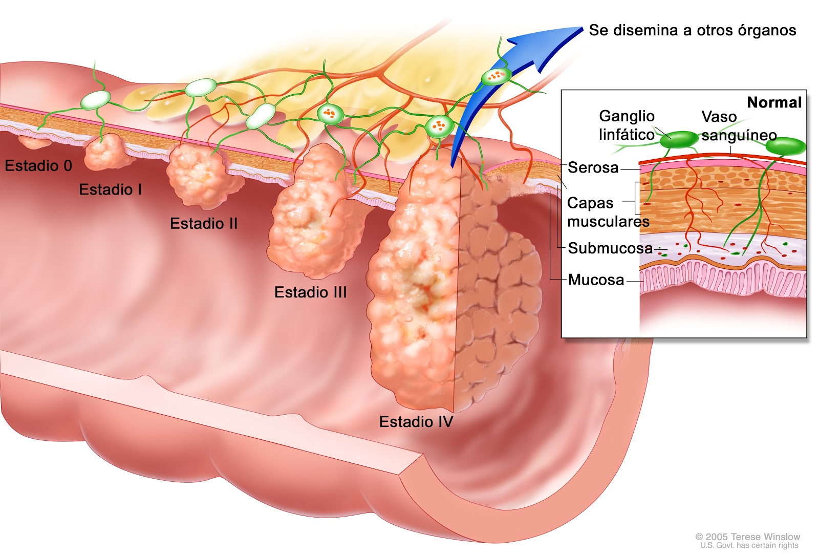 mastitis el cáncer de próstata causa dolor de espalda mastitis el cáncer de próstata causa dolor de espalda