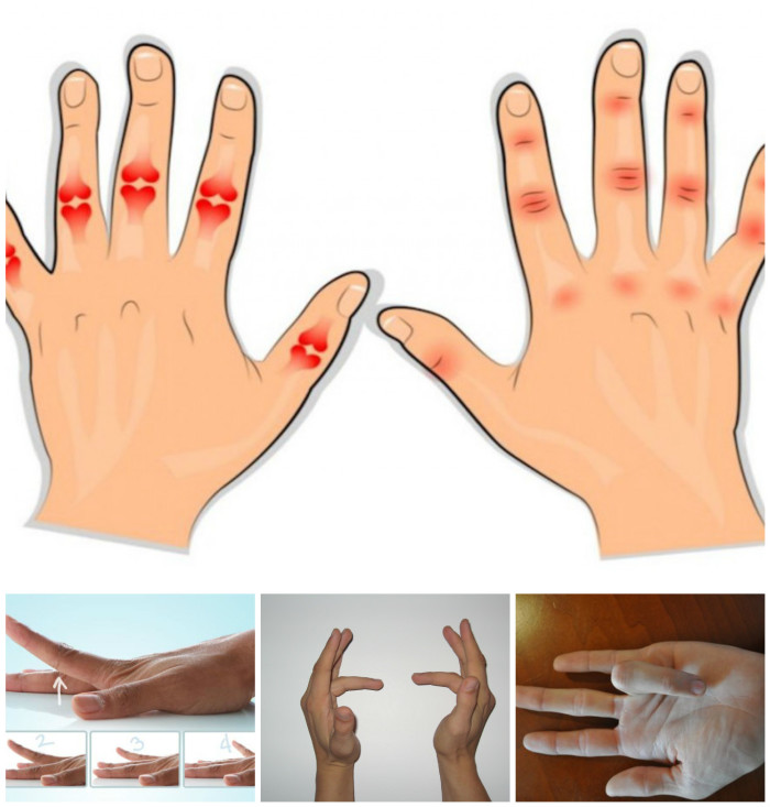12 Simple Exercises And Home Remedies To Relieve Arthritis Pain In Your