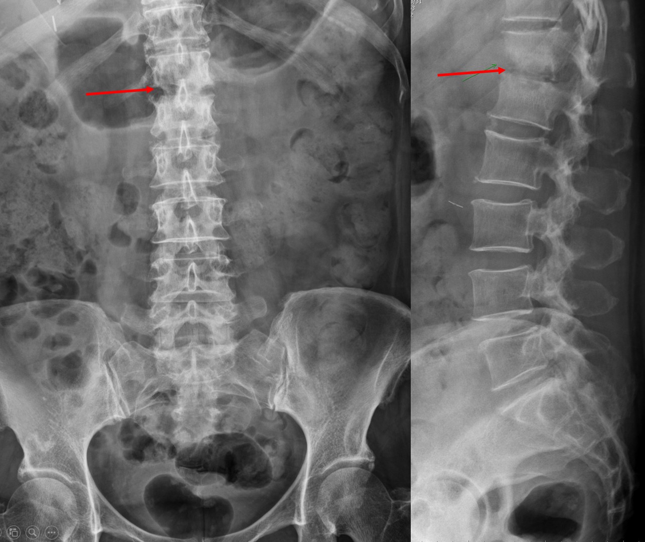 脊柱脊髓手术的定位 - 脑医汇 - 神外资讯 - 神介资讯