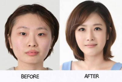 15 Foto 'Before - After' Hasil Operasi Plastik yang Menakjubkan