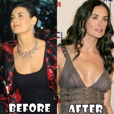 Demi Moore Plastic Surgery Before and After Nose Job and Botox - Star