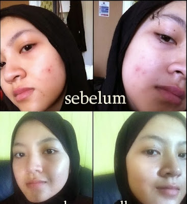 TESTIMONI VITAMIN C INJECTION