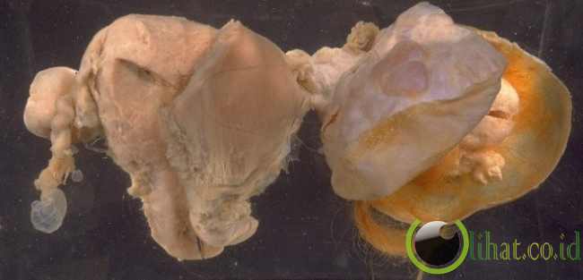 Kanker Ovarium Penyebab Tandatanda Dan Pengobatan