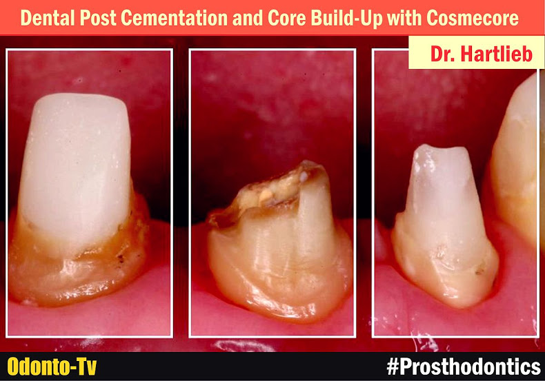 ENDOPOST Dental Post Cementation and Core BuildUp with Cosmecore